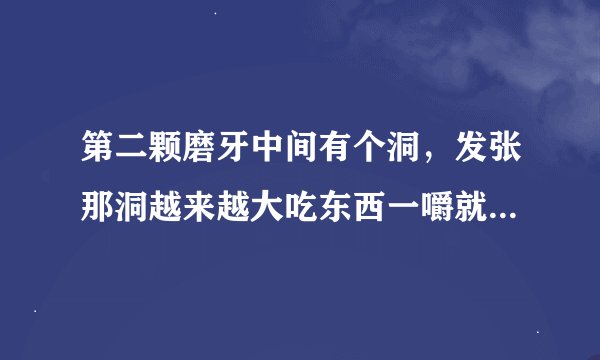第二颗磨牙中间有个洞，发张那洞越来越大吃东西一嚼就痛已经有半年多了，半年一直都是都是这样，