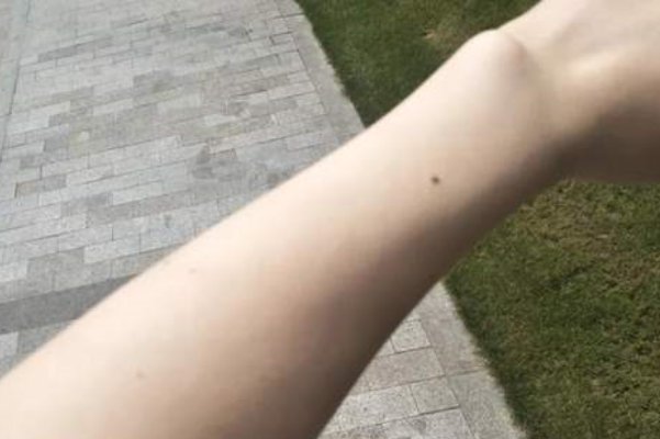 脸上的淤青怎么快速消除?