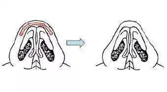 缩小鼻翼的方法有哪些