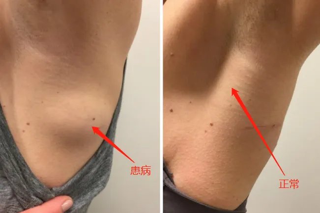 腋下脂肪瘤图片