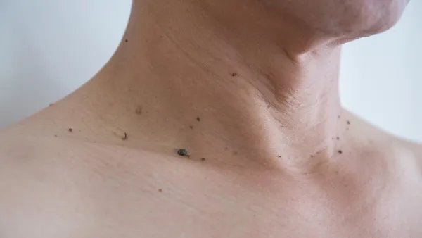 黑色素痣是怎么回事
