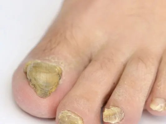 脚趾甲痛是怎么回事