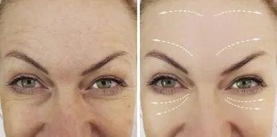 抬头纹怎么去除 去除抬头纹的几个方法介绍