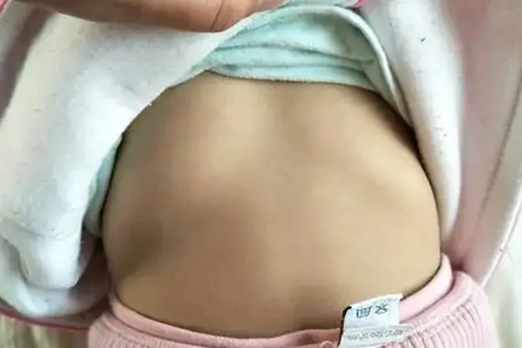 小孩鸡胸和正常胸图片