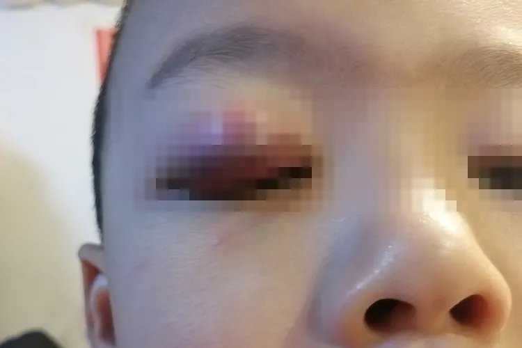 麦粒肿早期图片