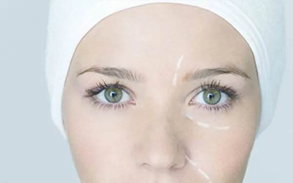 激光除皱的价格