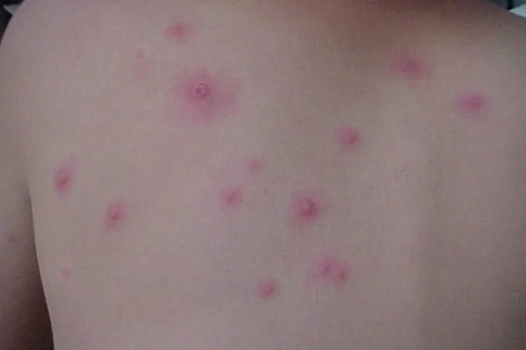 疱疹长什么样子图