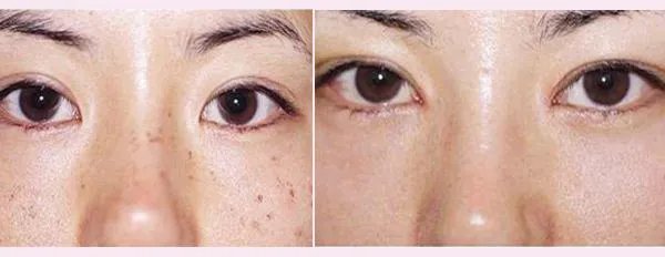 激光整形多少钱