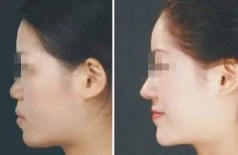 软骨隆鼻手术多少钱