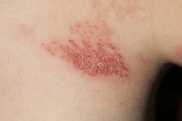 带状疱疹小红疙瘩图片