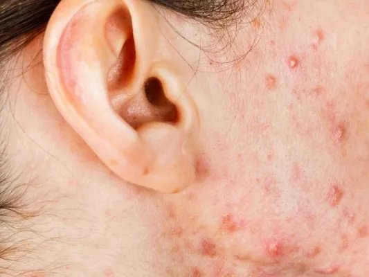 排毒养颜胶囊去痘吗