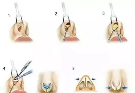 爱美?来看看如何隆鼻吧!