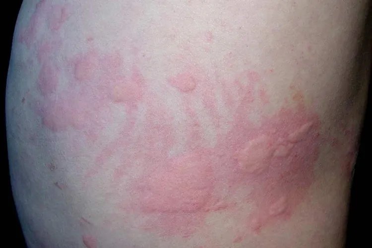 甲醛会导致身体出现哪些状况图片