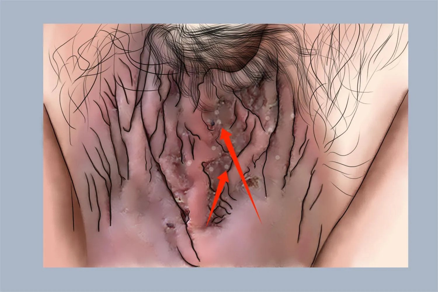 湿疹阴囊症状图片