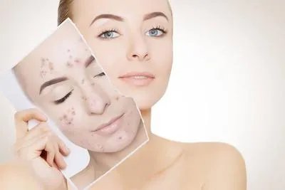 红蓝光祛痘有效吗 了解红蓝光祛痘的好处和坏处