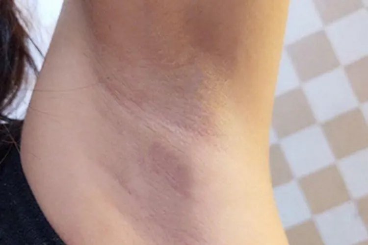 女性乳腺癌早期的图片大全