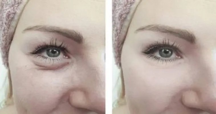 去除眼袋的方法有哪些 推荐5个小妙招去眼袋