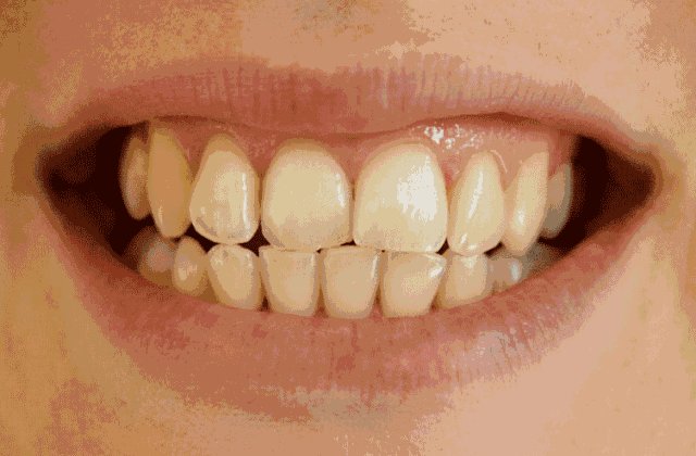 美白牙齿价格是多少