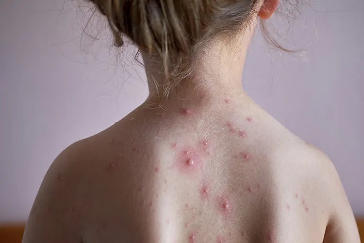 怎么判断是不是水痘图片