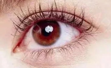 双眼皮埋线手术注意事项