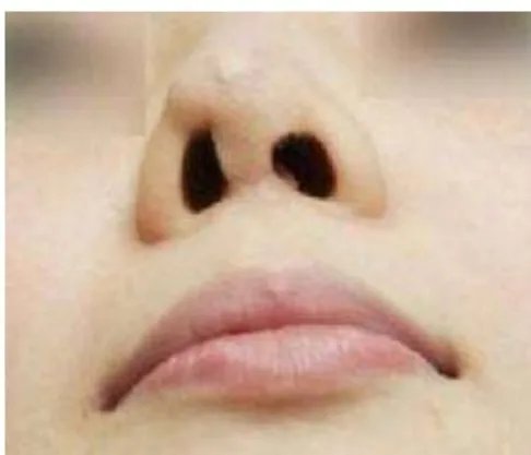 做隆鼻手术会有危害吗？