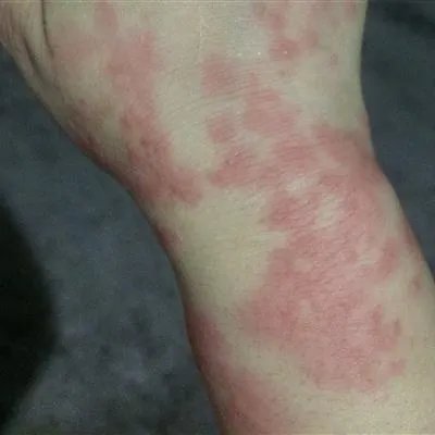 麻疹危害及症状是什么