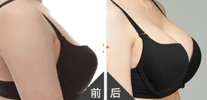 妙桃假体隆胸价格