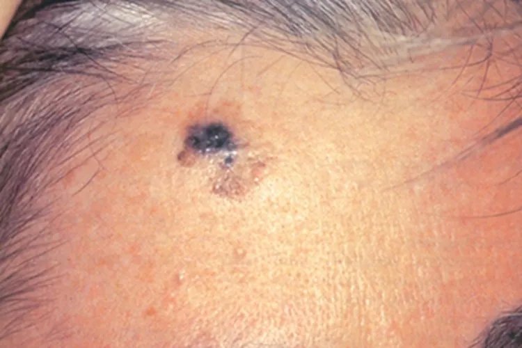 黑素瘤黑斑图片