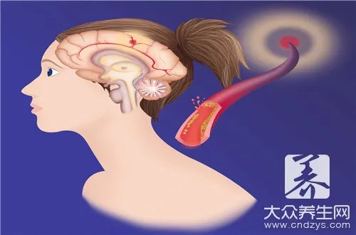 脑干梗塞的典型症状