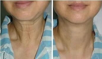 脖子除皱多少钱