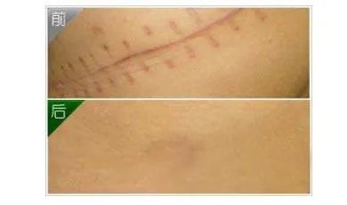 手术疤痕应该怎么修复