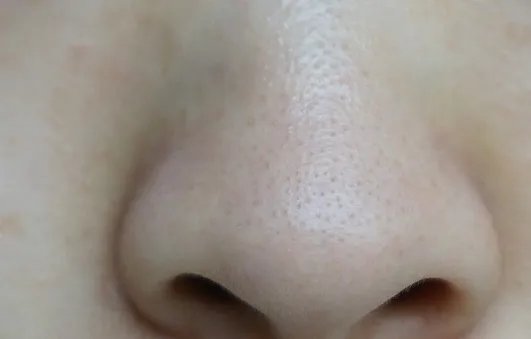 竹炭牙膏怎么去黑头