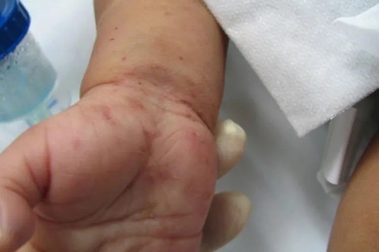 寄生虫性皮肤病图片