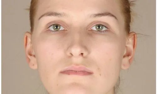 做光子嫩肤对皮肤有伤害吗