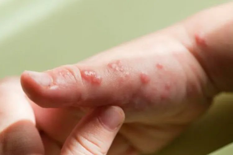 手上起小水疱很痒怎么回事图片