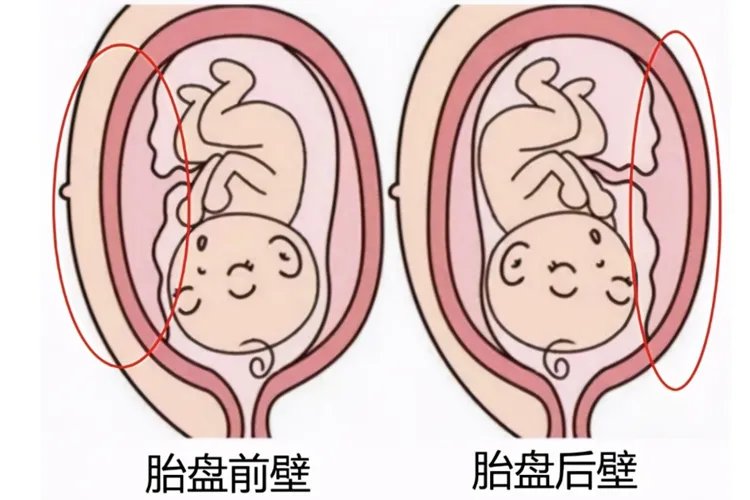 胎盘位置前壁是什么意思