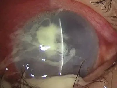 细菌性角膜炎症状图片