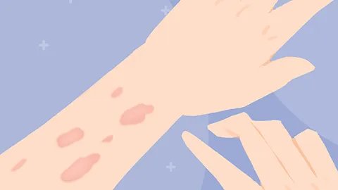 治疗鸡眼的药有哪些