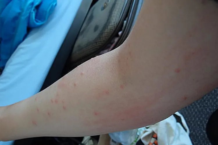 寄生虫性皮肤病图片