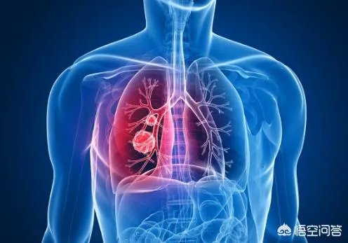 李咏得了什么病？