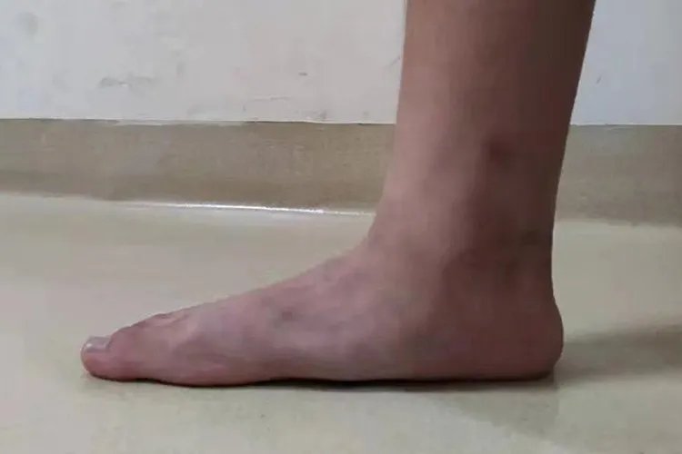 直脚板与正常脚区别图