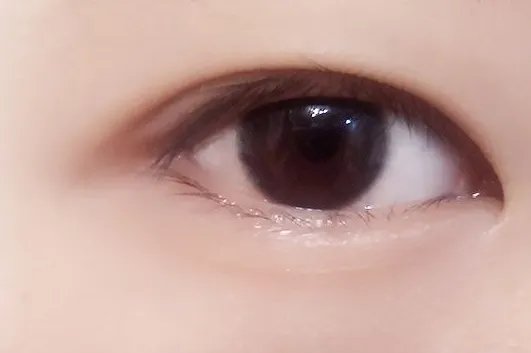 广州整形双眼皮多少钱