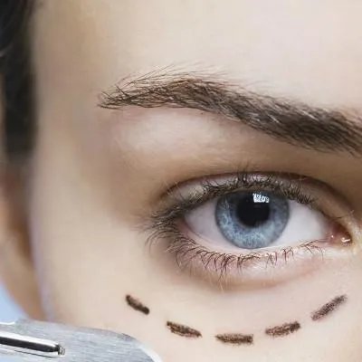 韩式去眼袋有什么好