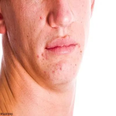 男生长痘痘如何处理 分享男士祛痘方法