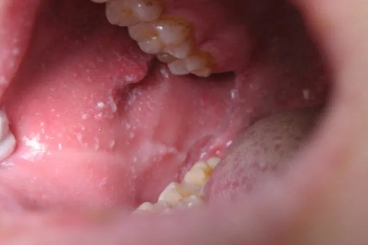 麻疹荨麻疹图片