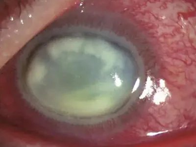 细菌性角膜炎症状图片