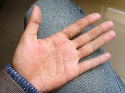 3级手足综合征症状图片