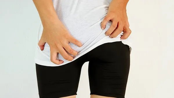 肛门湿疹怎么办