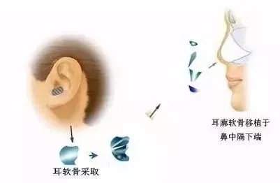 爱美?来看看如何隆鼻吧!