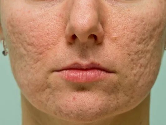 治疗痤疮的好方法